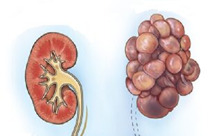 Що таке мультикістоз нирок