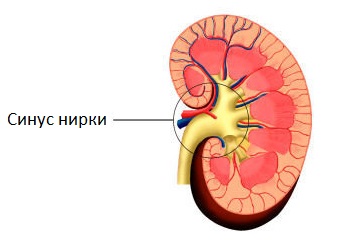 Що таке кіста ниркового сінусу