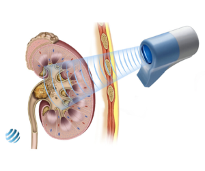 Дроблення каменів у нирках ультразвуком