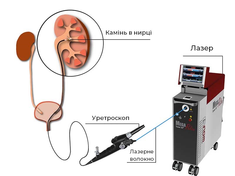 Як видалити камені в нирках лазером