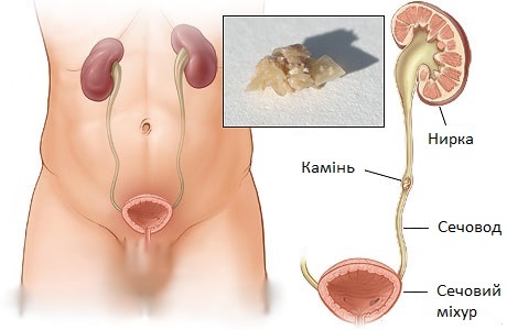 Як виходить камінь з нирки у чоловіка