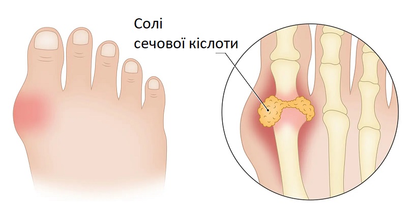 Як лікувати подагру