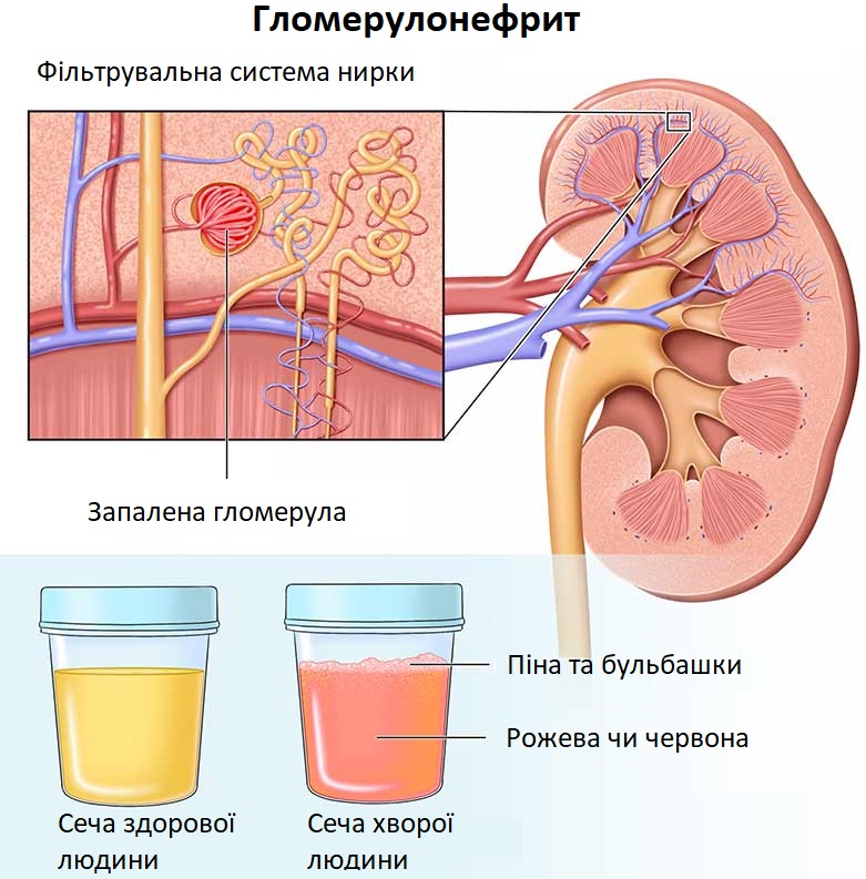 Симптоми гломерулонефриту