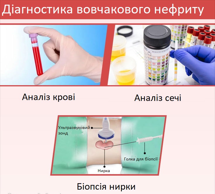 Як виявити вовчаковий нефрит