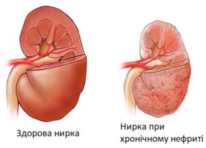 Чому виникає хронічний нефрит