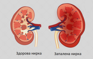 Чим відрізняється нефрит