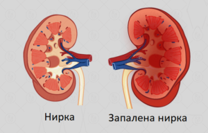 Від чого буває запалення нирки