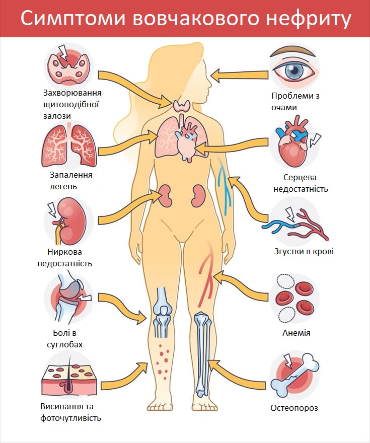 Які симптоми вовчакового нефриту